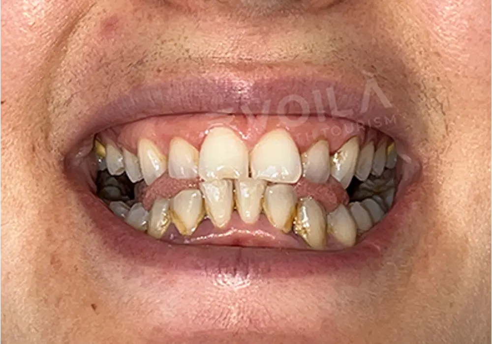 Teeth Whitening - Voila Health Tourism - Volia Clinic - Dr Furkan Certel