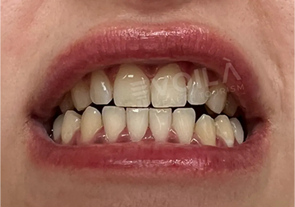 Teeth Whitening - Voila Health Tourism - Volia Clinic - Dr Furkan Certel