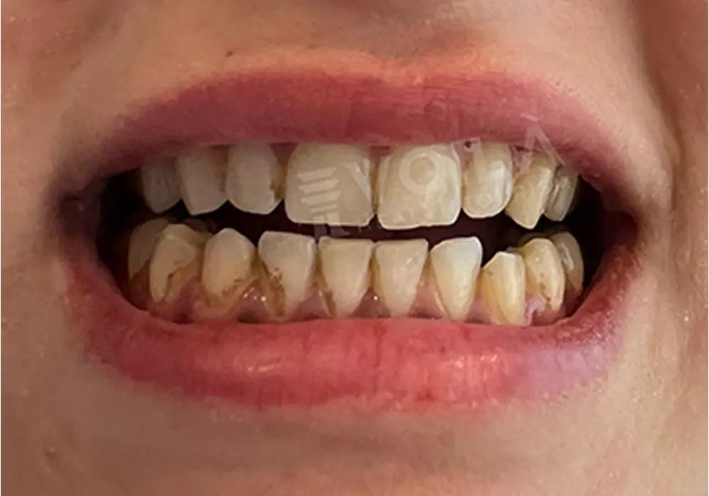 Teeth Whitening - Voila Health Tourism - Volia Clinic - Dr Furkan Certel