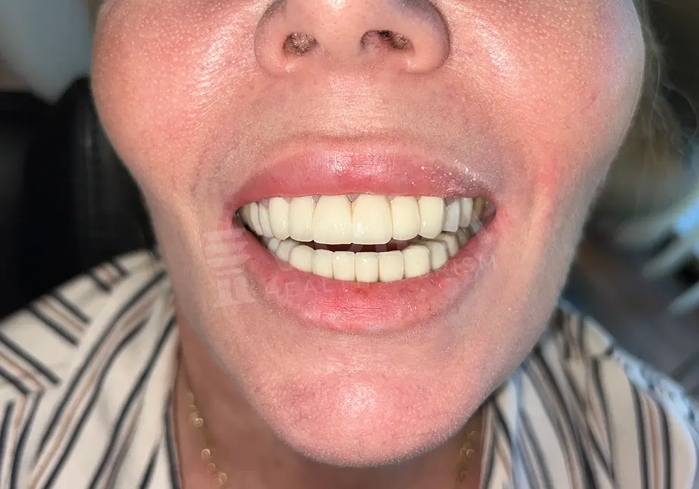 Dental Lamina - Voila Health