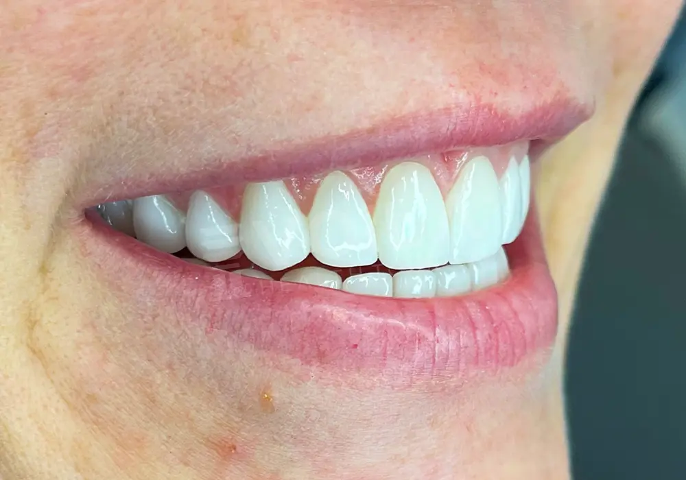 Dental Lamina - Voila Health