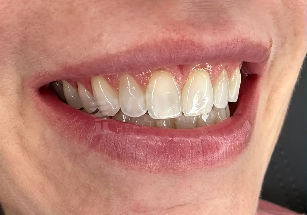 Dental Lamina - Voila Health