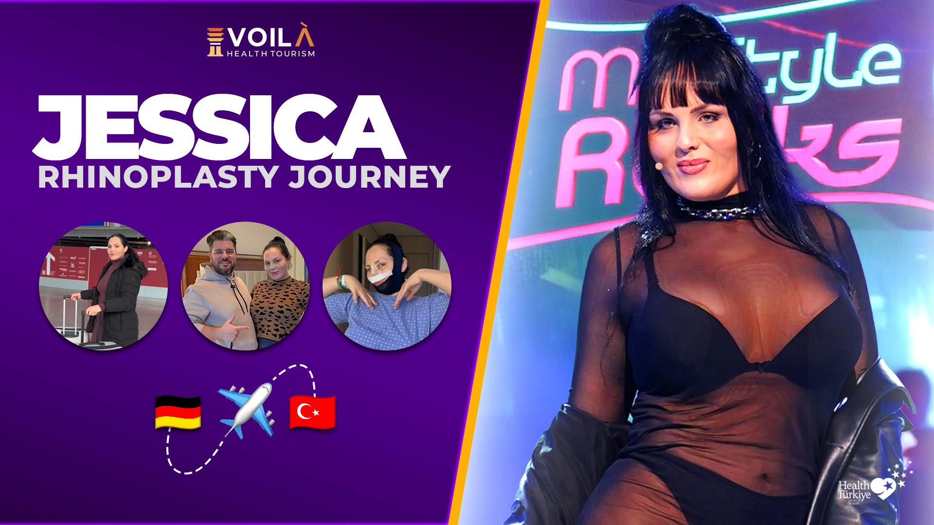 Jessica Wagner’s Transformation: BBL, 360 Lipo & Revision Rhinoplasty with Dr. Furkan